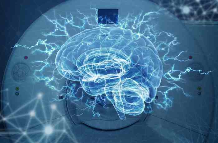 Echelon neurology strokes post test